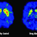 drug abuse and the brain